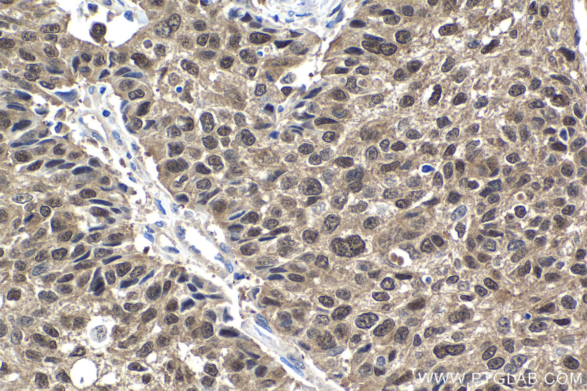 Immunohistochemistry (IHC) staining of human lung cancer tissue using MAGEA4 Polyclonal antibody (12508-1-AP)