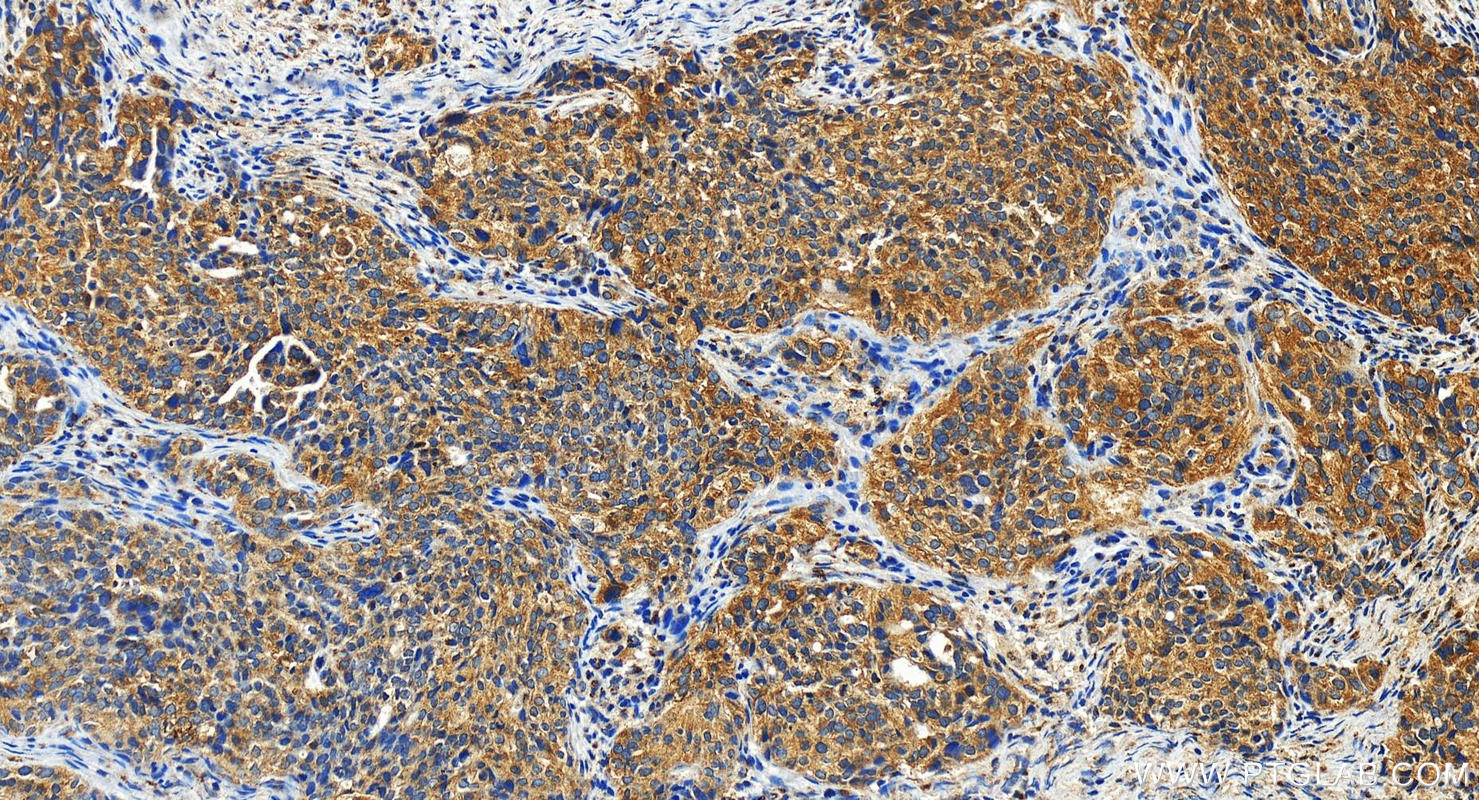 Immunohistochemistry (IHC) staining of human ovary cancer tissue using MAN1A1 Polyclonal antibody (23382-1-AP)