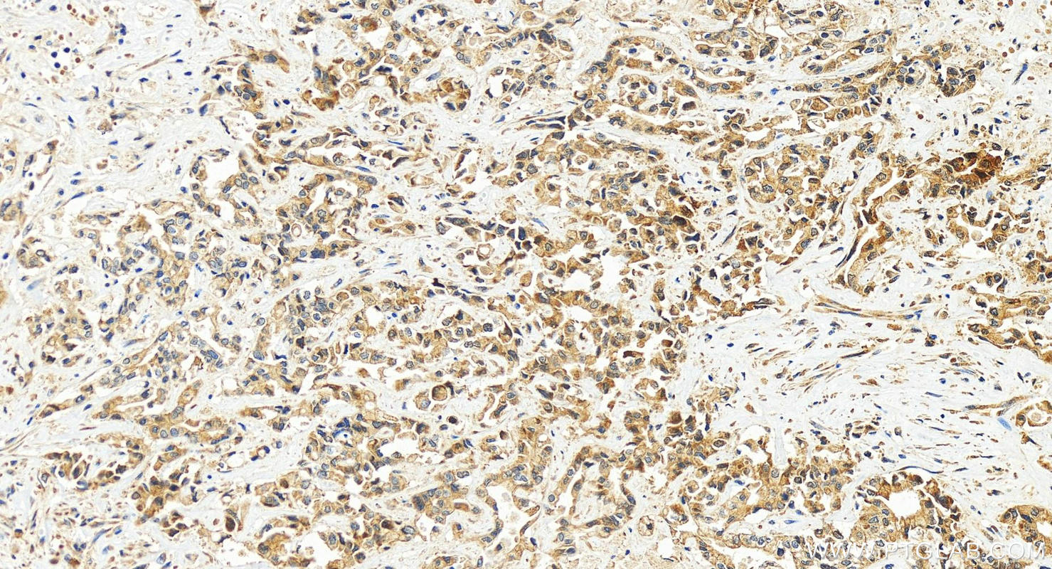 Immunohistochemistry (IHC) staining of human intrahepatic cholangiocarcinoma tissue using MEKK2 Polyclonal antibody (55106-1-AP)