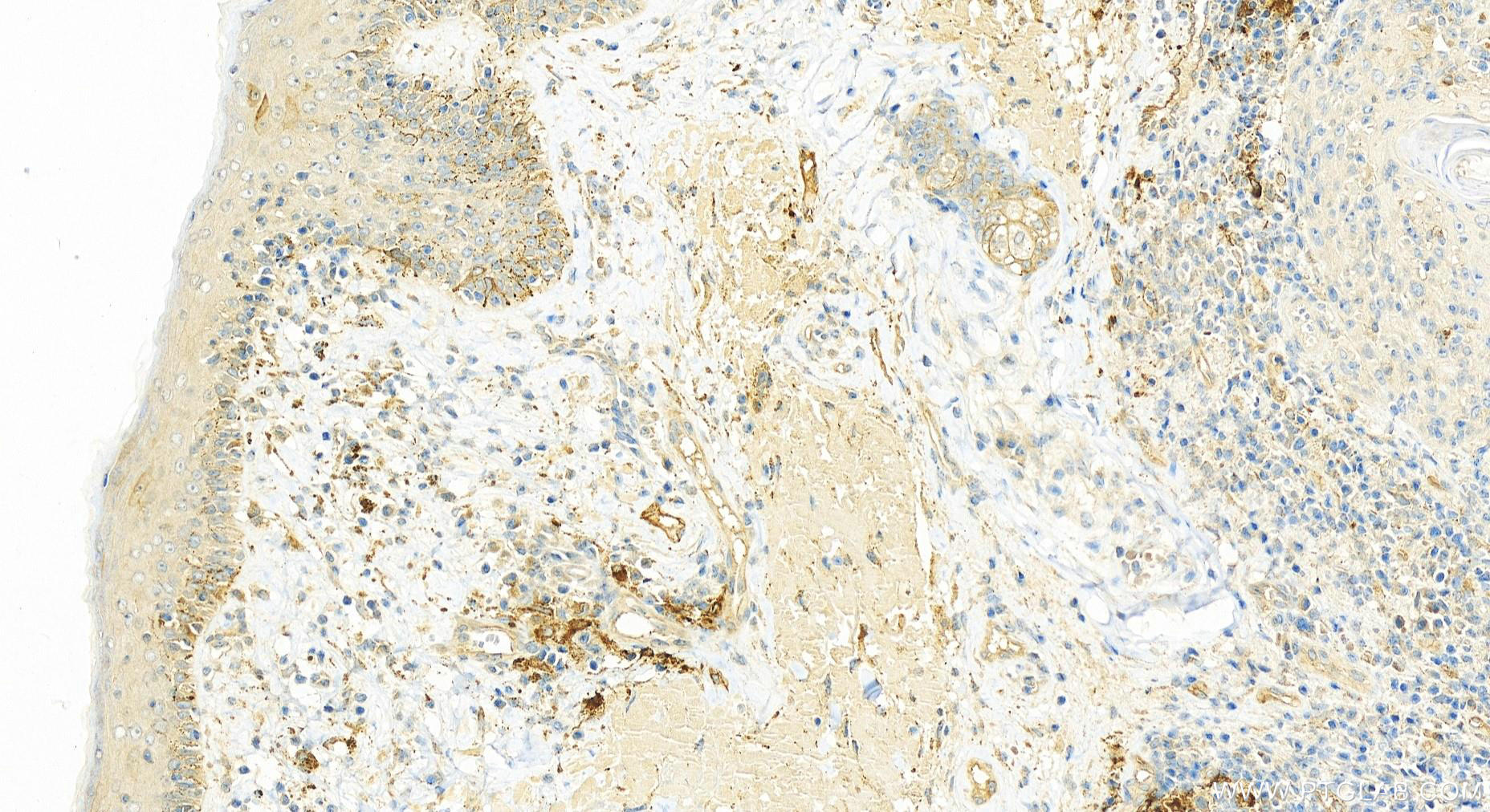 Immunohistochemistry (IHC) staining of skin cancer using MARCKSL1 Polyclonal antibody (14124-1-AP)