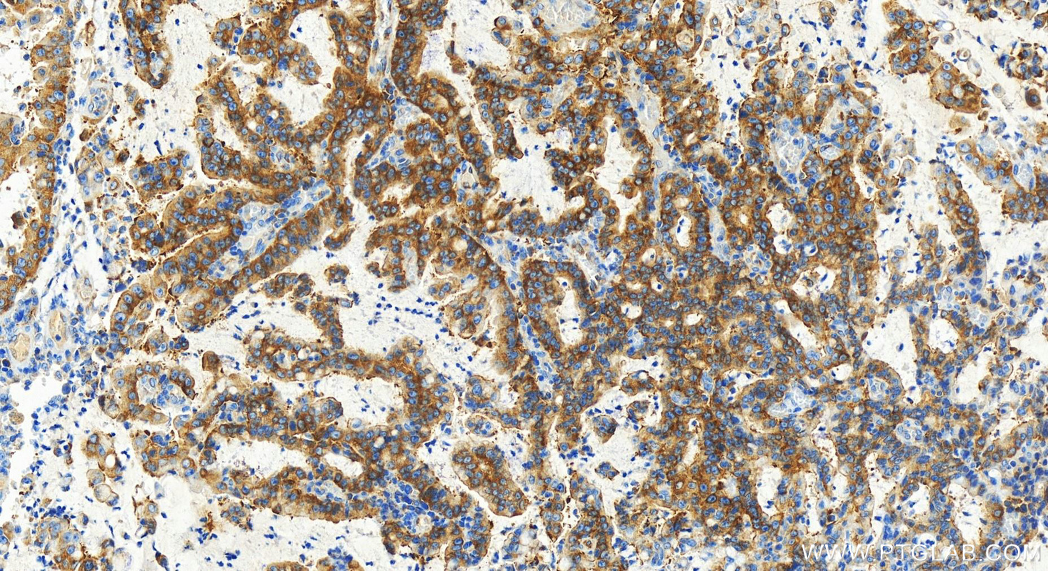 Immunohistochemistry (IHC) staining of human stomach cancer tissue using MARS Recombinant antibody (83690-4-RR)