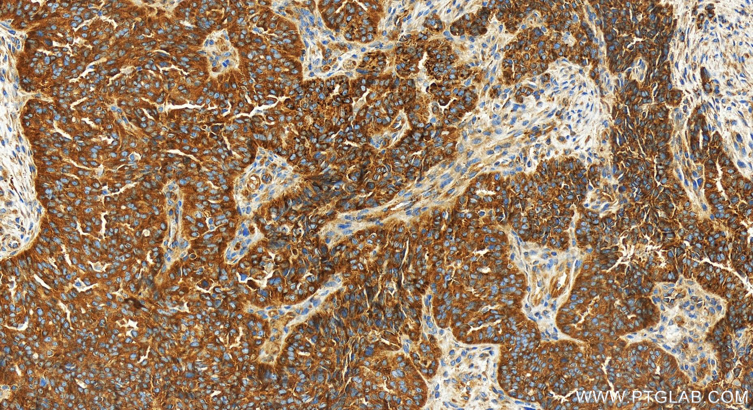 Immunohistochemistry (IHC) staining of human ovarian cancer using MARS Recombinant antibody (83690-5-RR)