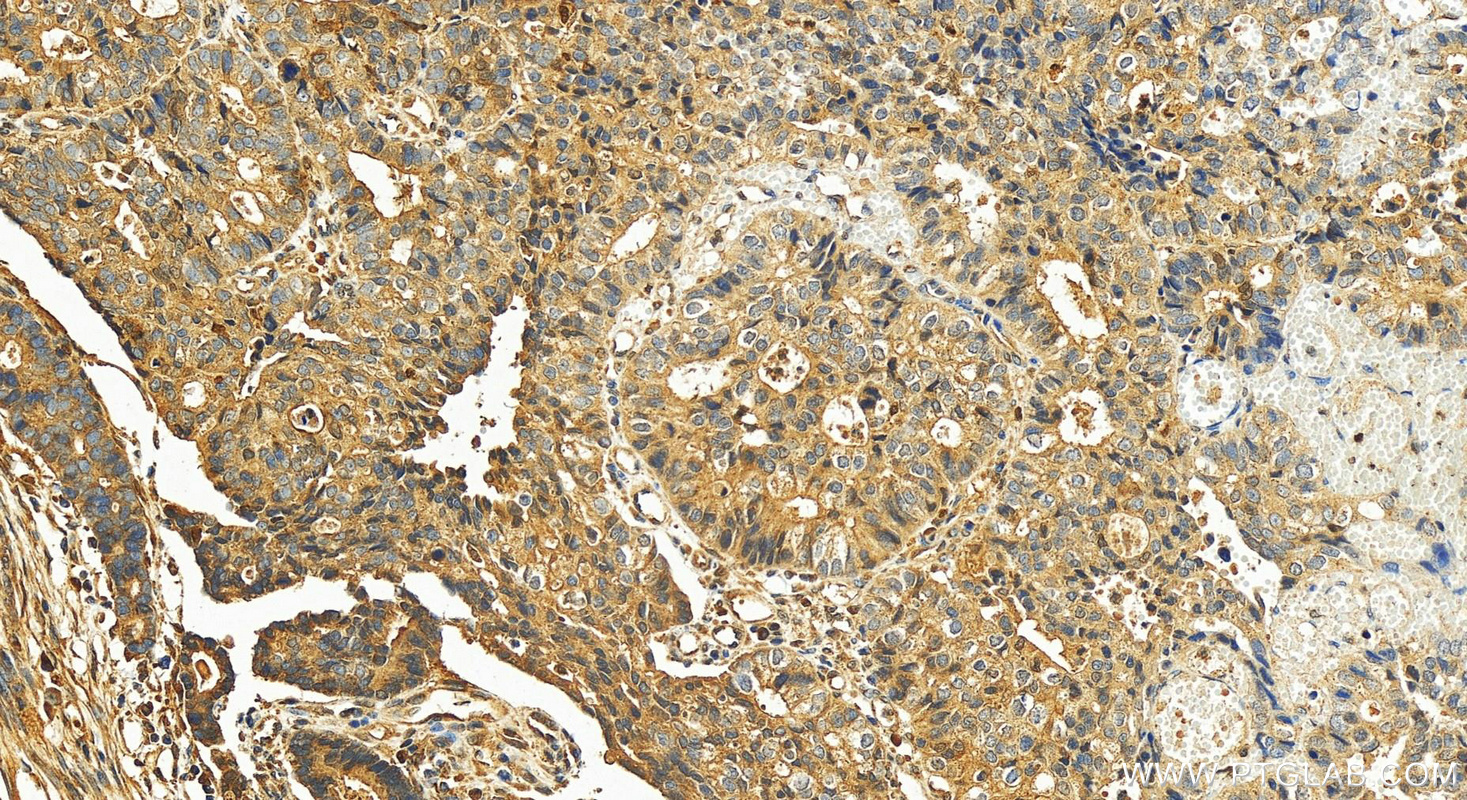 Immunohistochemistry (IHC) staining of human stomach cancer tissue using MATN3 Polyclonal antibody (25500-1-AP)