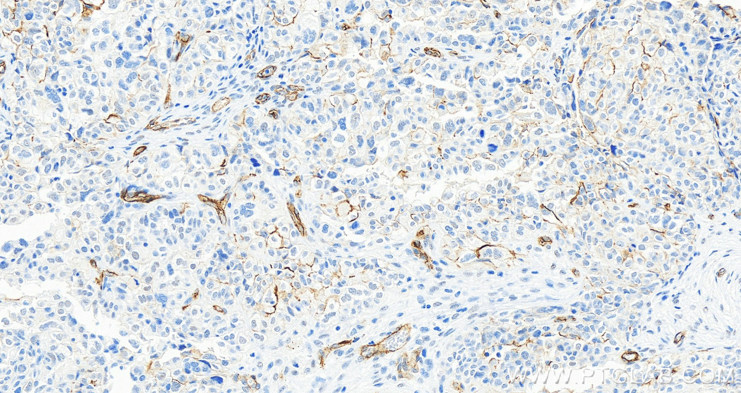 Immunohistochemistry (IHC) staining of human ovary cancer tissue using CD146/MCAM Polyclonal antibody (17564-1-AP)