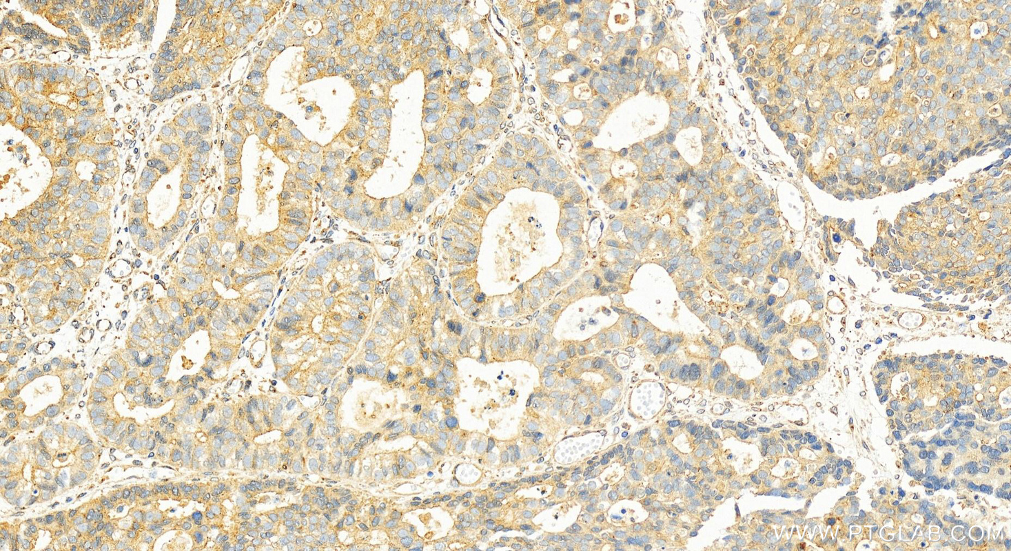 Immunohistochemistry (IHC) staining of human stomach cancer tissue using MCCC1 Polyclonal antibody (30081-1-AP)