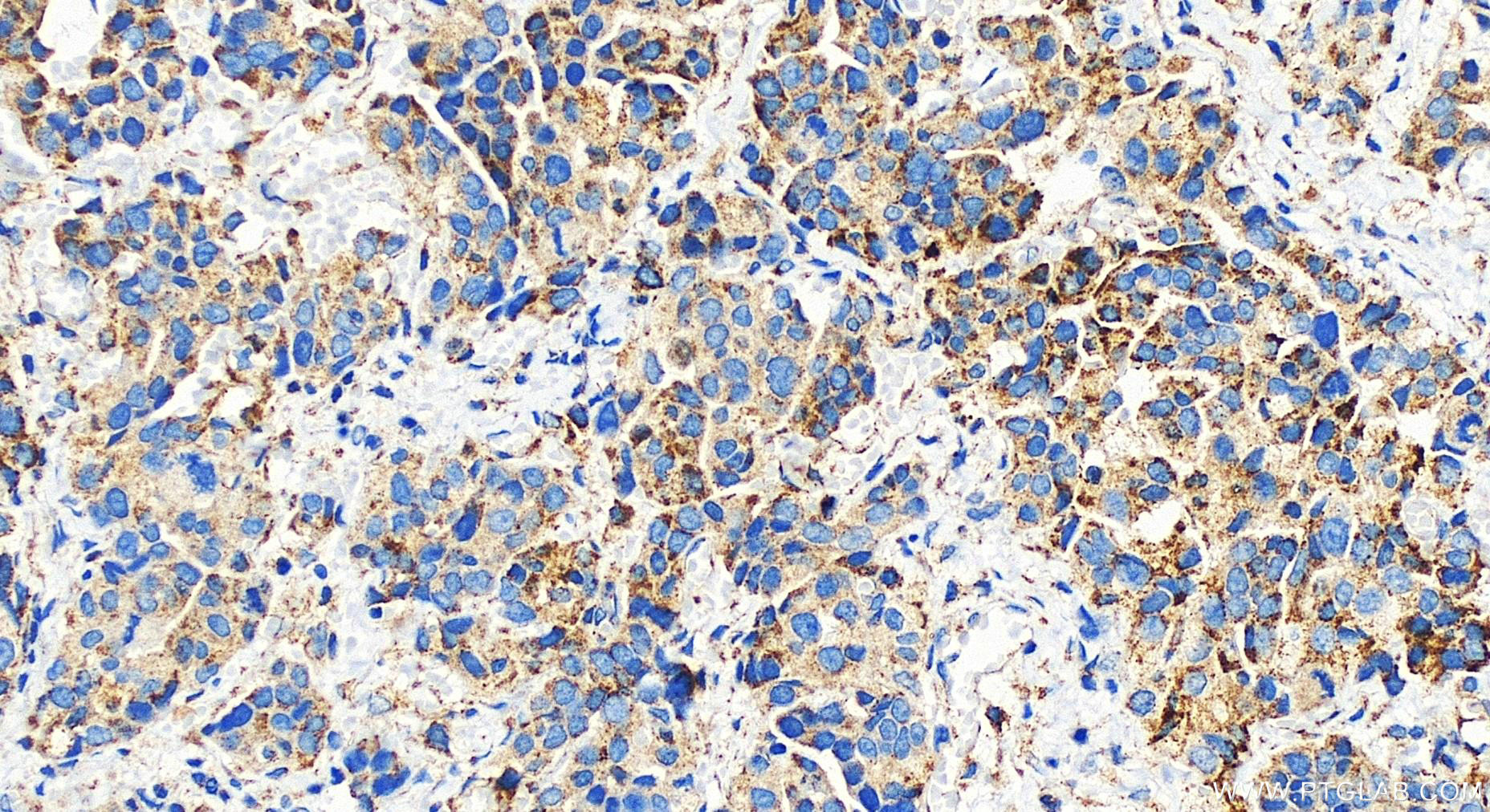 Immunohistochemistry (IHC) staining of human ovary cancer tissue using MCCC1 Polyclonal antibody (30081-1-AP)