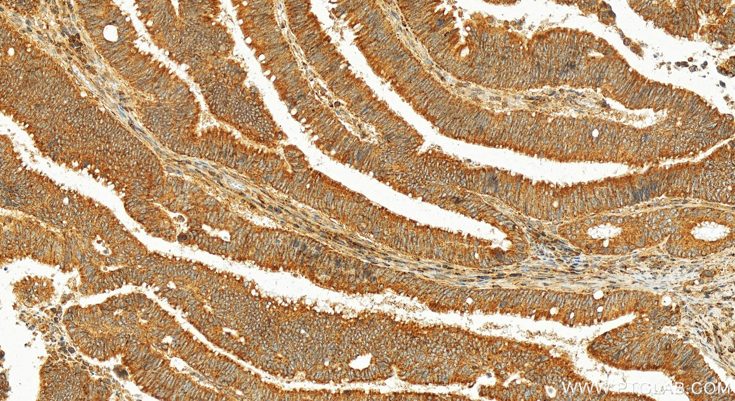 Immunohistochemistry (IHC) staining of human colon  cancer using MCL1 Polyclonal antibody (16225-1-AP)