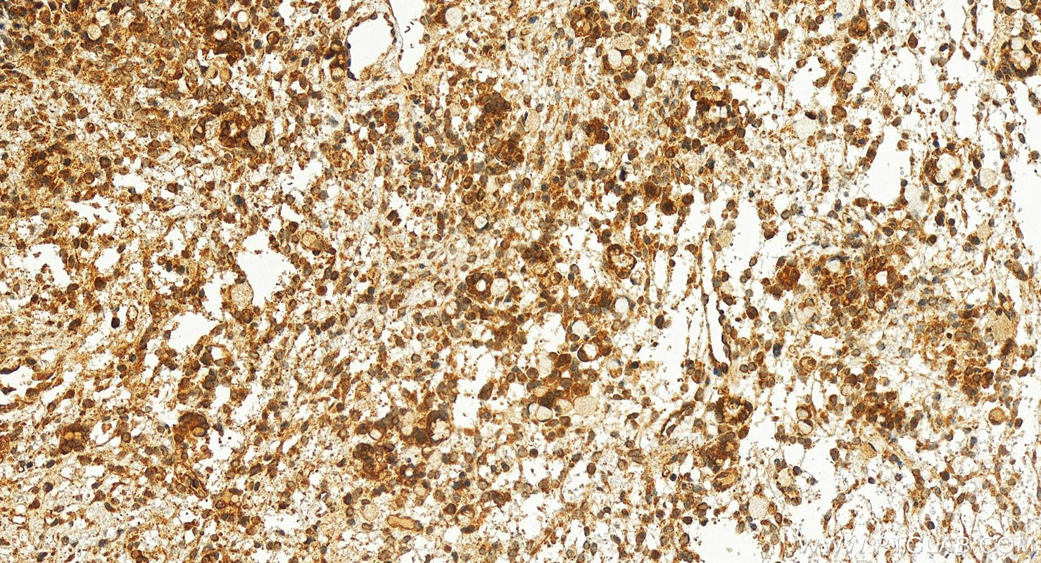 Immunohistochemistry (IHC) staining of human ovary cancer tissue using MCL1 Polyclonal antibody (16225-1-AP)