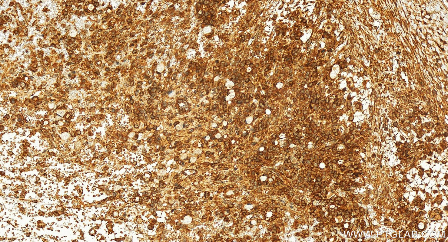 Immunohistochemistry (IHC) staining of human ovary cancer tissue using MCL1 Polyclonal antibody (16225-1-AP)