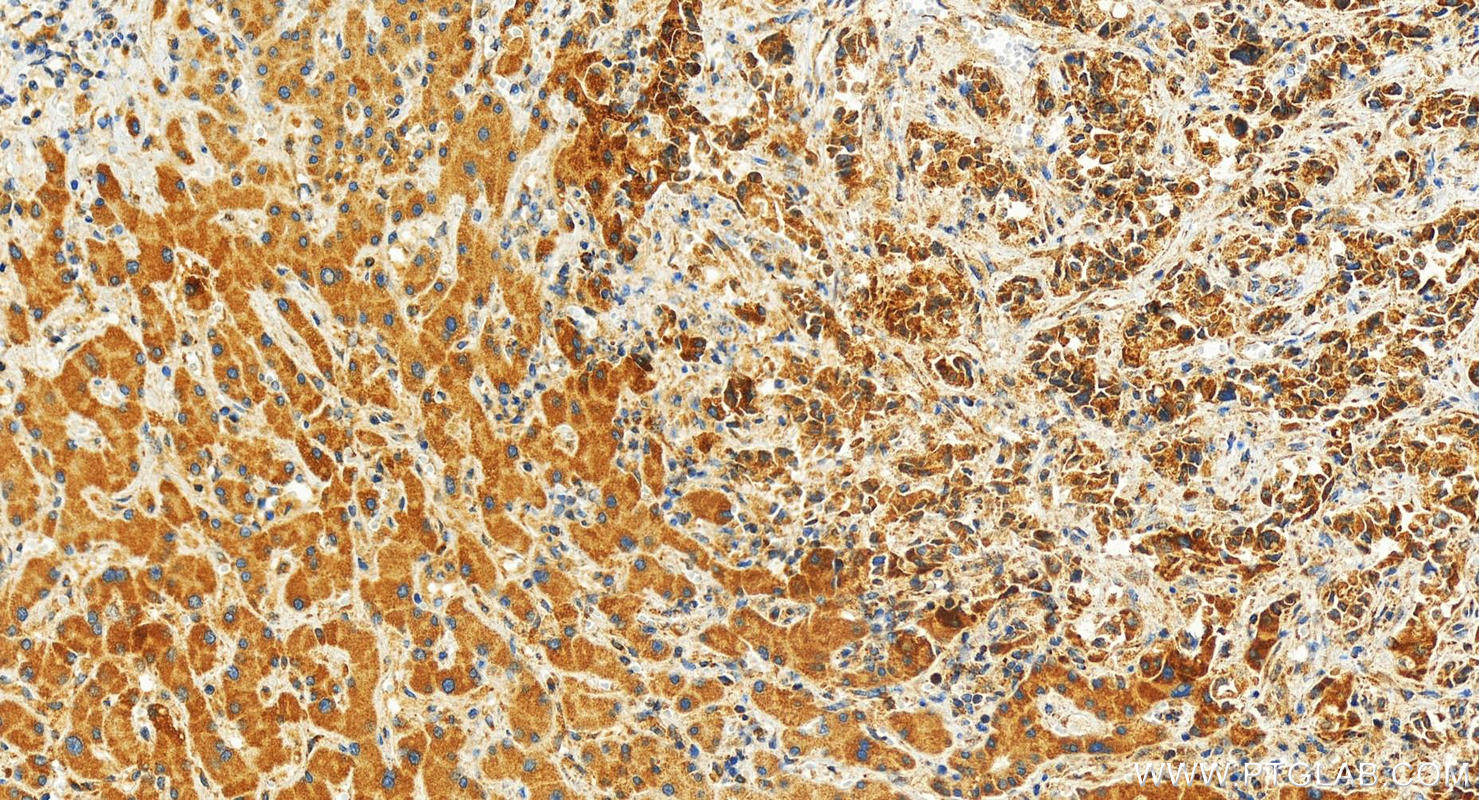 Immunohistochemistry (IHC) staining of human intrahepatic cholangiocarcinoma tissue using MCL1 Recombinant antibody (82695-2-RR)