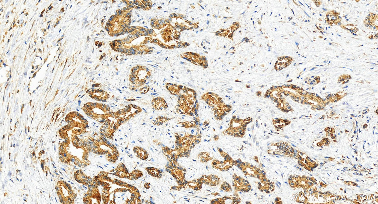 Immunohistochemistry (IHC) staining of human intrahepatic cholangiocarcinoma tissue using MCL1 Recombinant antibody (82695-2-RR)