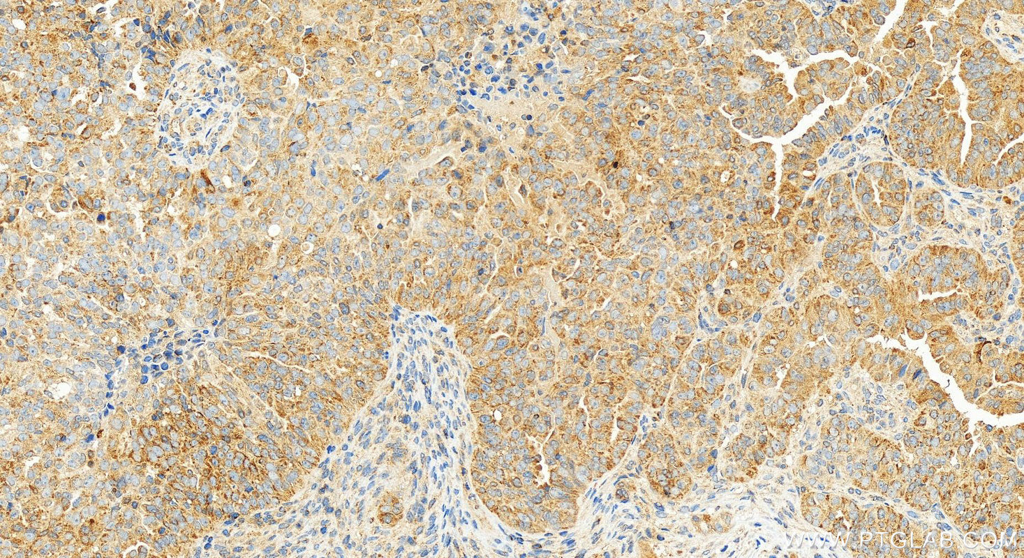 Immunohistochemistry (IHC) staining of human ovarian  cancer using MCL1 Recombinant antibody (82695-2-RR)