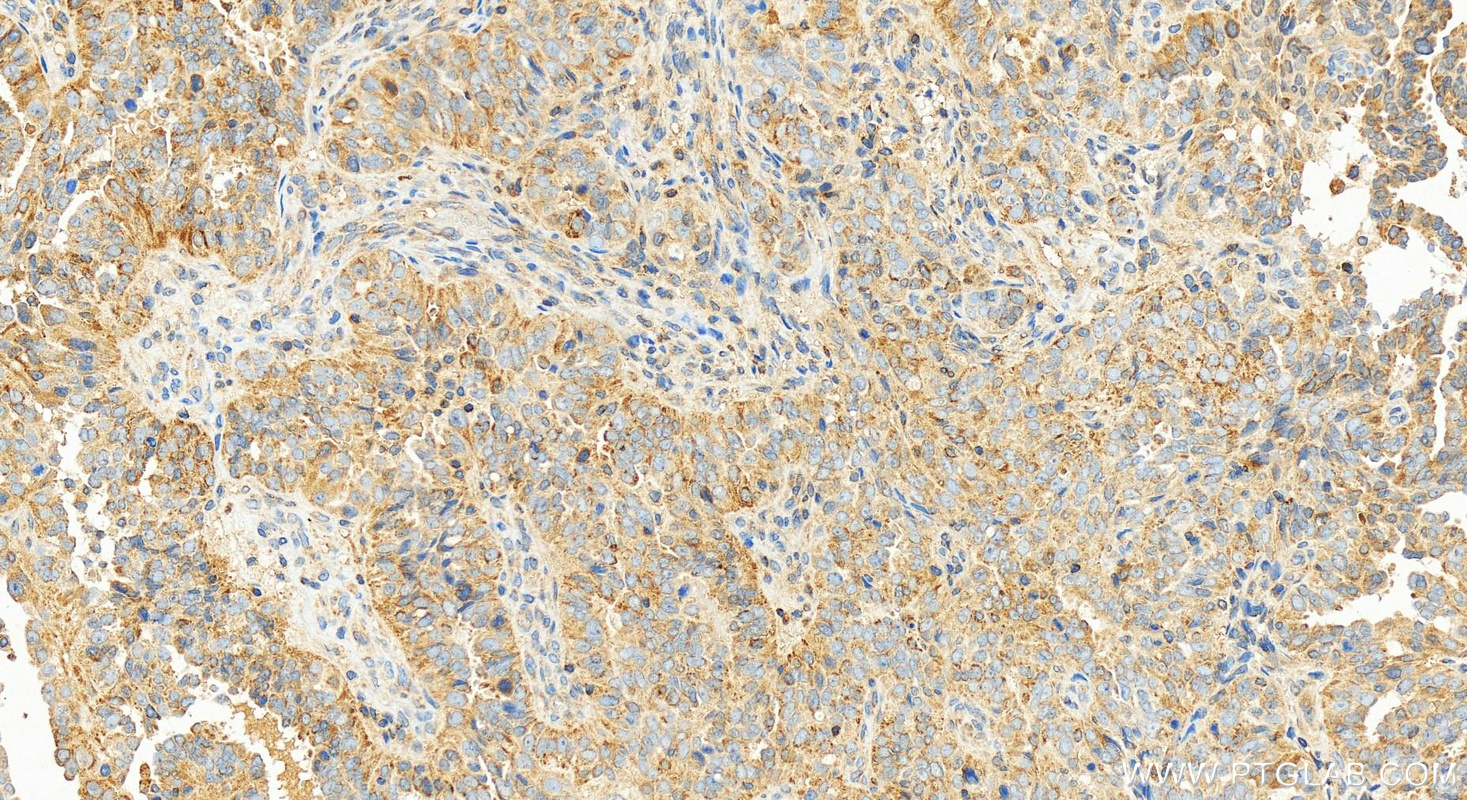 Immunohistochemistry (IHC) staining of human ovarian  cancer using MCL1 Recombinant antibody (82695-2-RR)