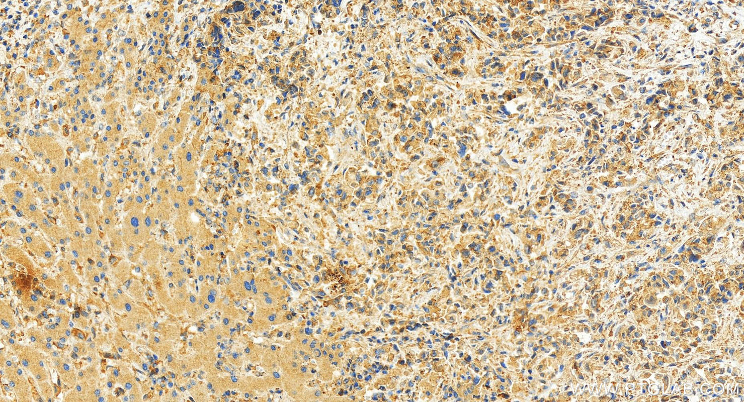 Immunohistochemistry (IHC) staining of human intrahepatic cholangiocarcinoma tissue using MCL1 Recombinant antibody (82695-4-RR)