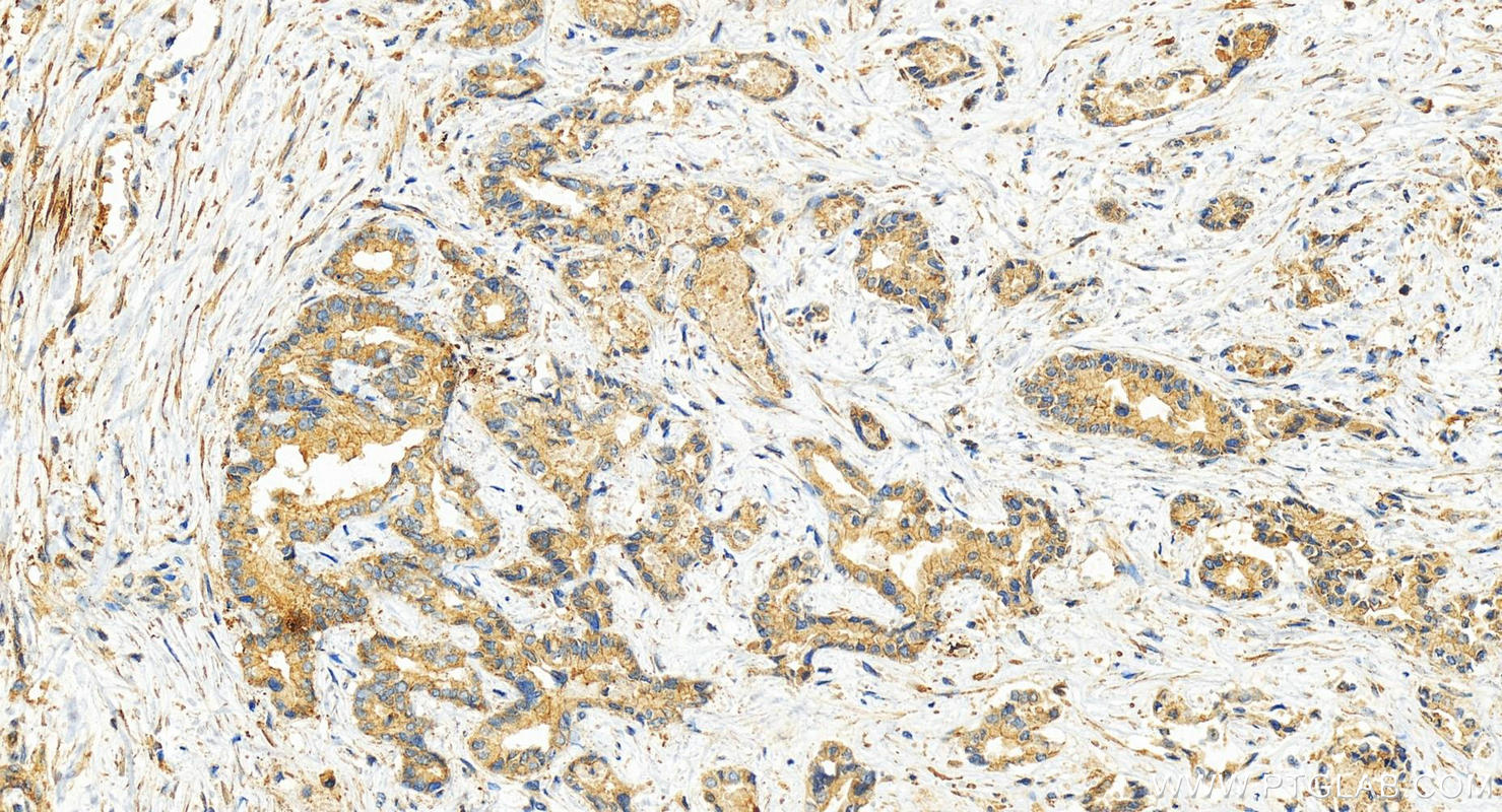 Immunohistochemistry (IHC) staining of human intrahepatic cholangiocarcinoma tissue using MCL1 Recombinant antibody (82695-4-RR)