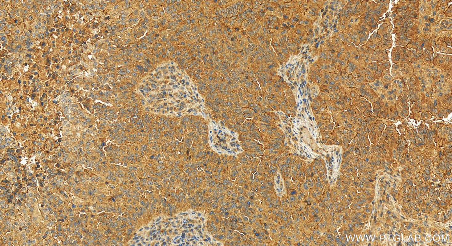 Immunohistochemistry (IHC) staining of human ovarian  cancer using MCL1 Recombinant antibody (82695-4-RR)