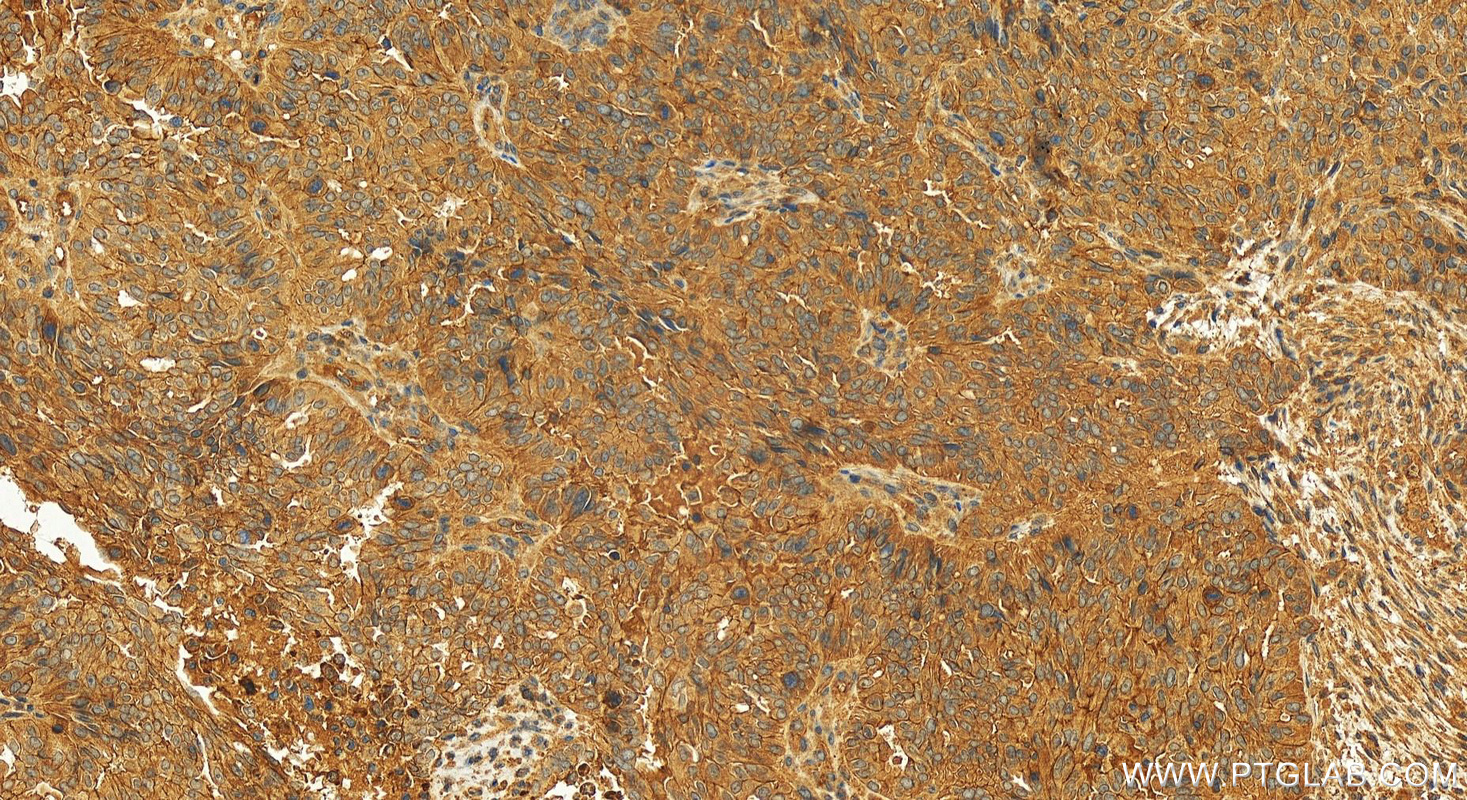 Immunohistochemistry (IHC) staining of human ovarian  cancer using MCL1 Recombinant antibody (82695-4-RR)