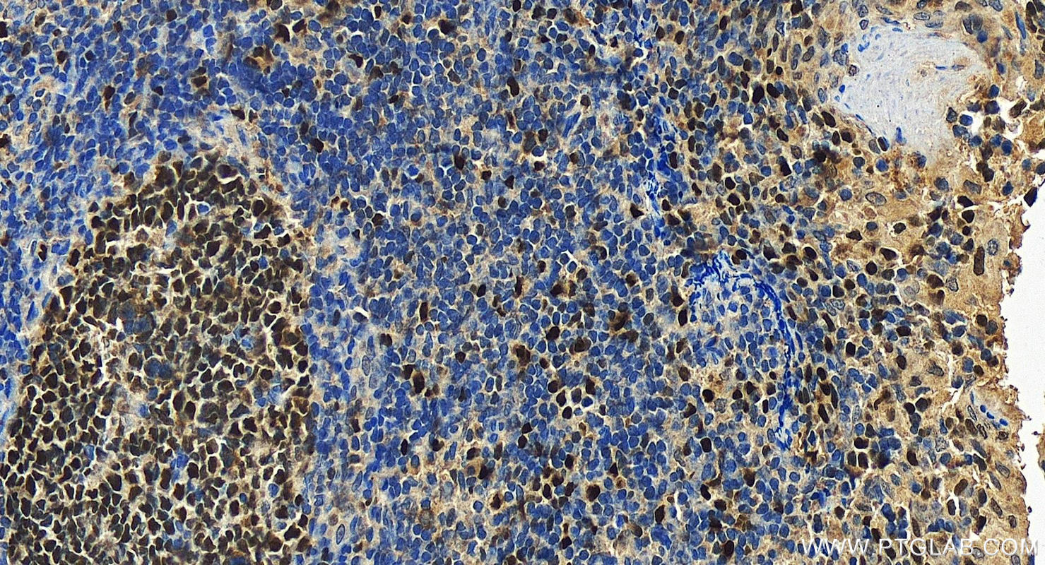 Immunohistochemistry (IHC) staining of human tonsillitis tissue using MCM2 Polyclonal antibody (10513-1-AP)