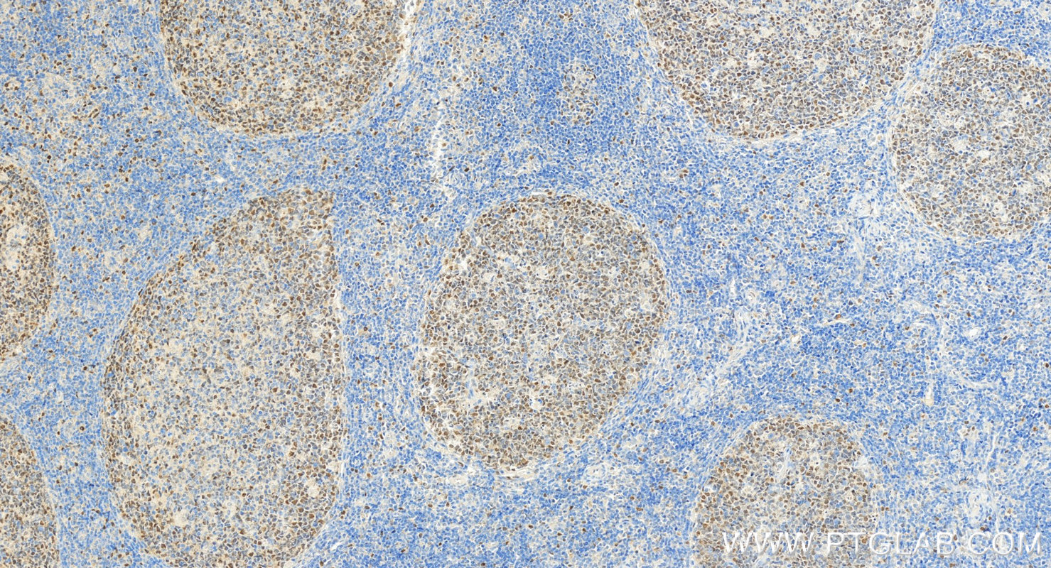 Immunohistochemistry (IHC) staining of human tonsillitis tissue using MCM2 Polyclonal antibody (10513-1-AP)