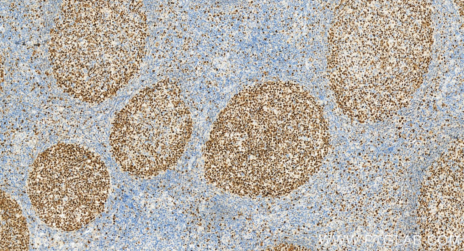 Immunohistochemistry (IHC) staining of Human tonsillitis tissue using MCM2 Monoclonal antibody (66204-1-Ig)