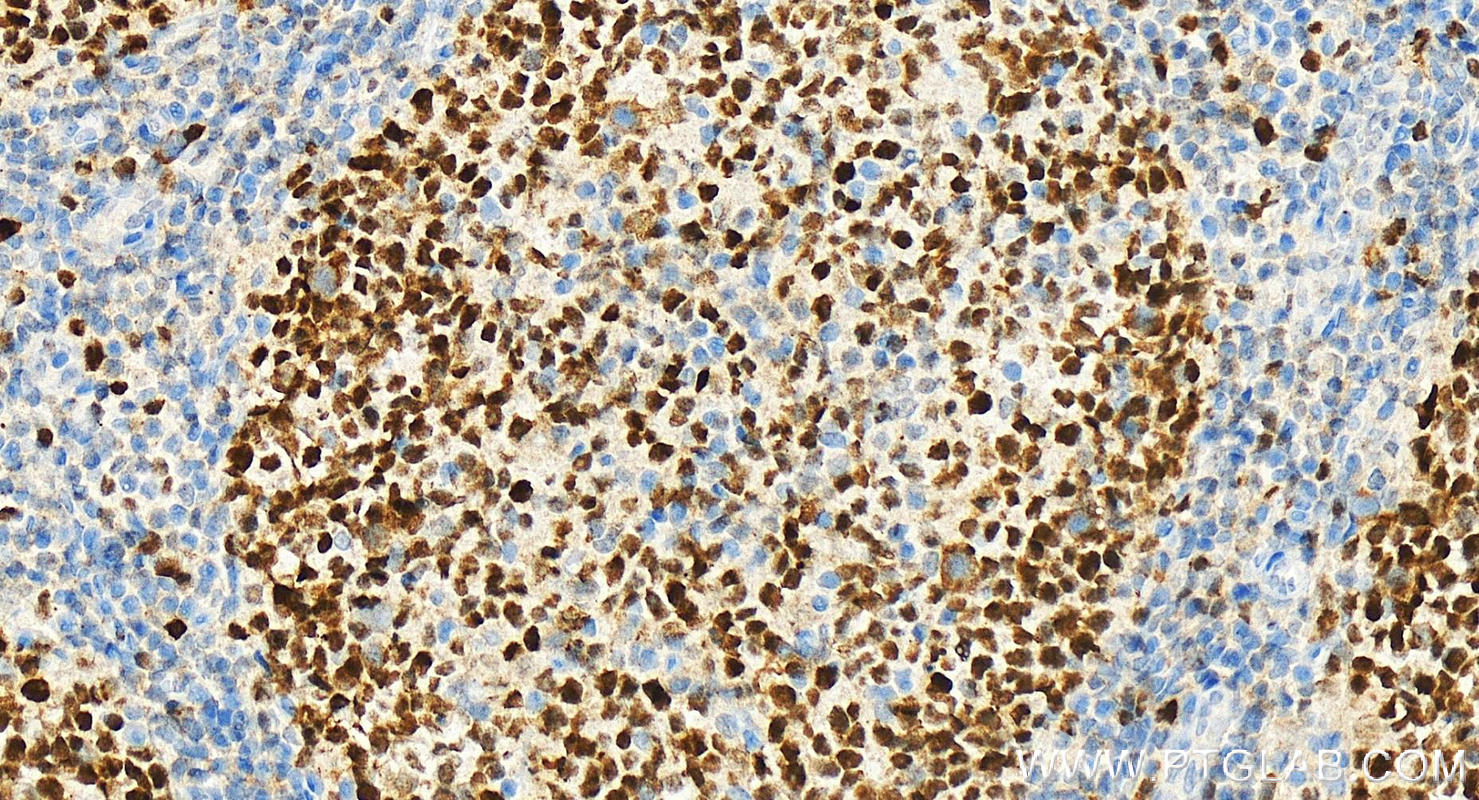 Immunohistochemistry (IHC) staining of Human tonsillitis tissue using MCM2 Monoclonal antibody (66204-1-Ig)