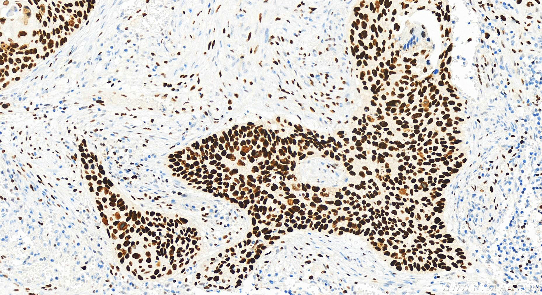 Immunohistochemistry (IHC) staining of human cervical squamous cancer tissue using MCM2 Recombinant antibody (84511-5-RR)