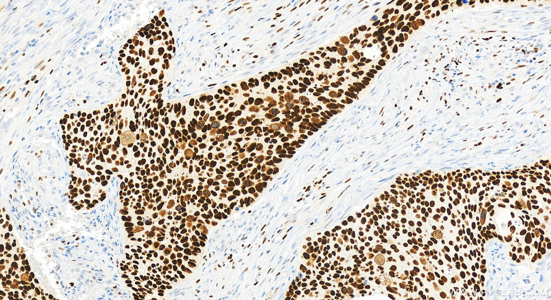 Immunohistochemistry (IHC) staining of human cervical squamous cancer tissue using MCM2 Recombinant antibody (84511-5-RR)