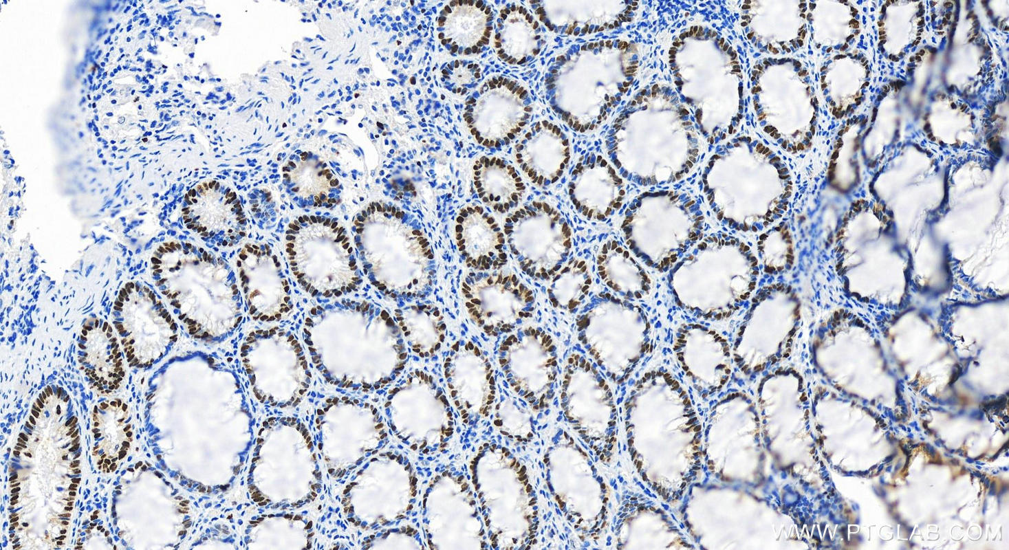 Immunohistochemistry (IHC) staining of human colon cancer tissue using MCM3 Polyclonal antibody (15597-1-AP)