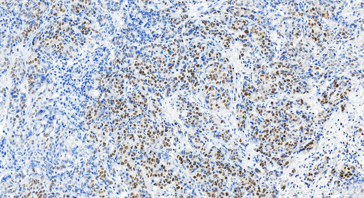 Immunohistochemistry (IHC) staining of human colon cancer tissue using MCM3 Polyclonal antibody (15597-1-AP)