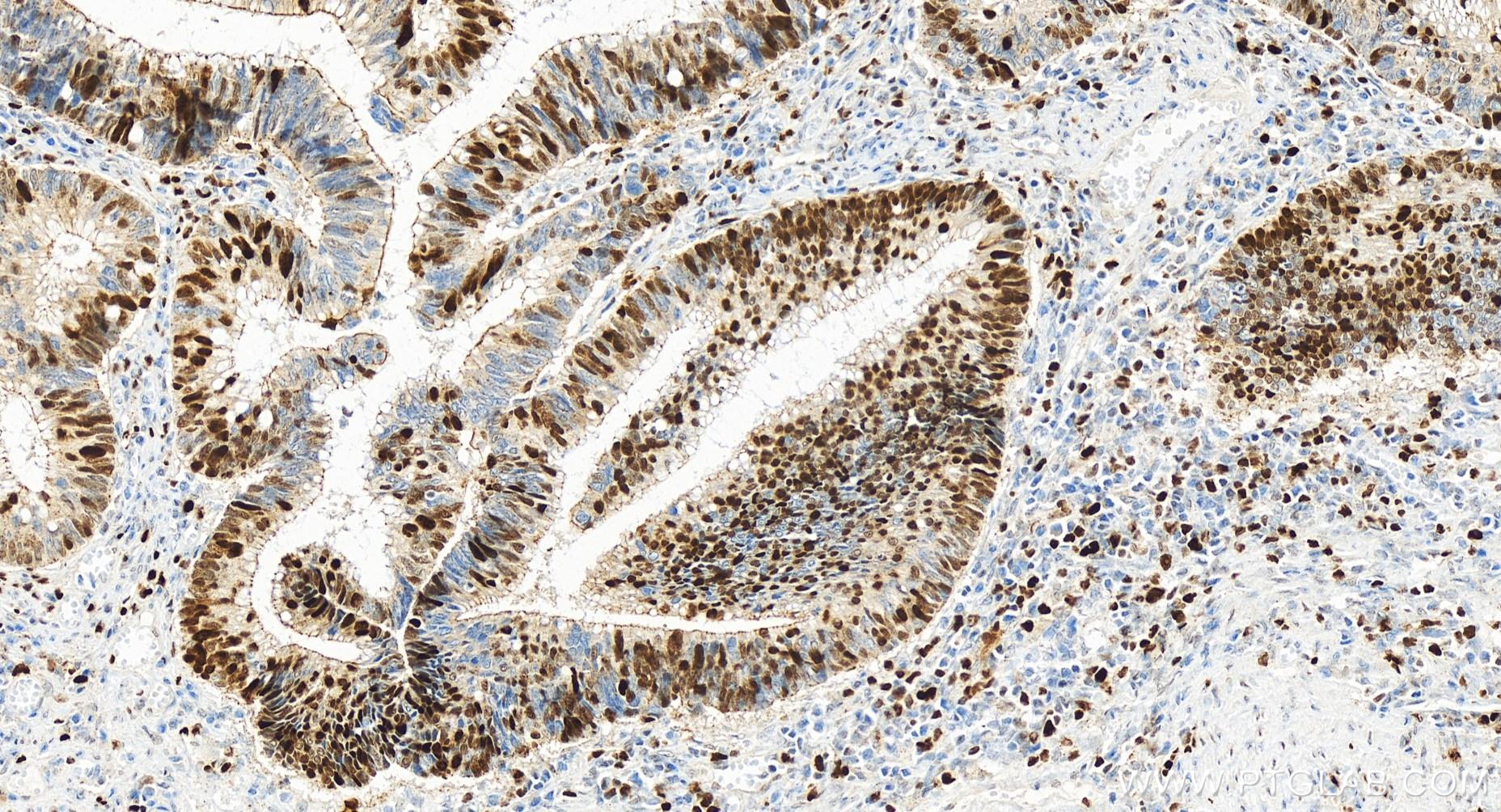 Immunohistochemistry (IHC) staining of human colon cancer tissue using MCM3 Recombinant antibody (84792-5-RR)