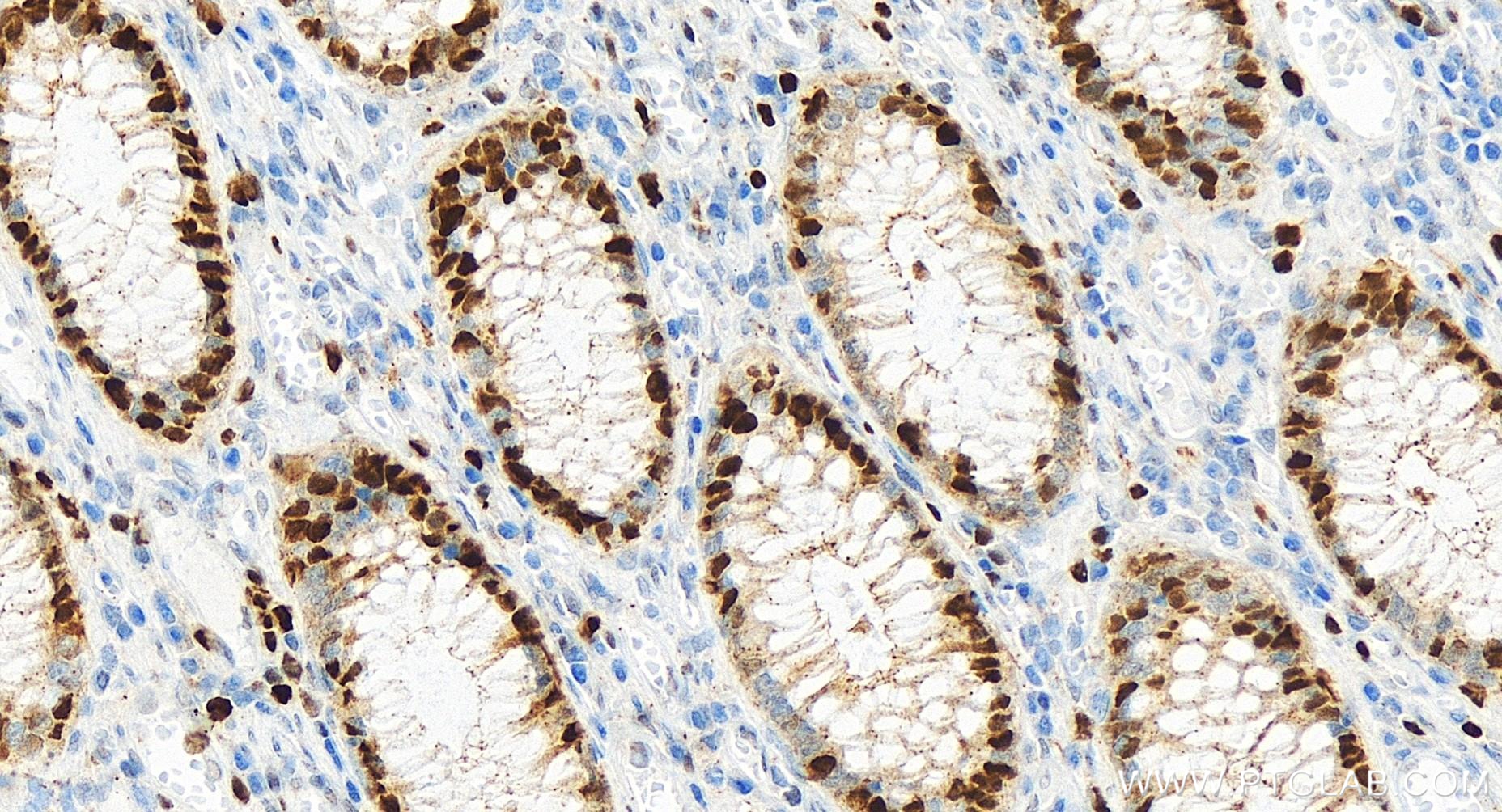 Immunohistochemistry (IHC) staining of human colon cancer tissue using MCM3 Recombinant antibody (84792-5-RR)