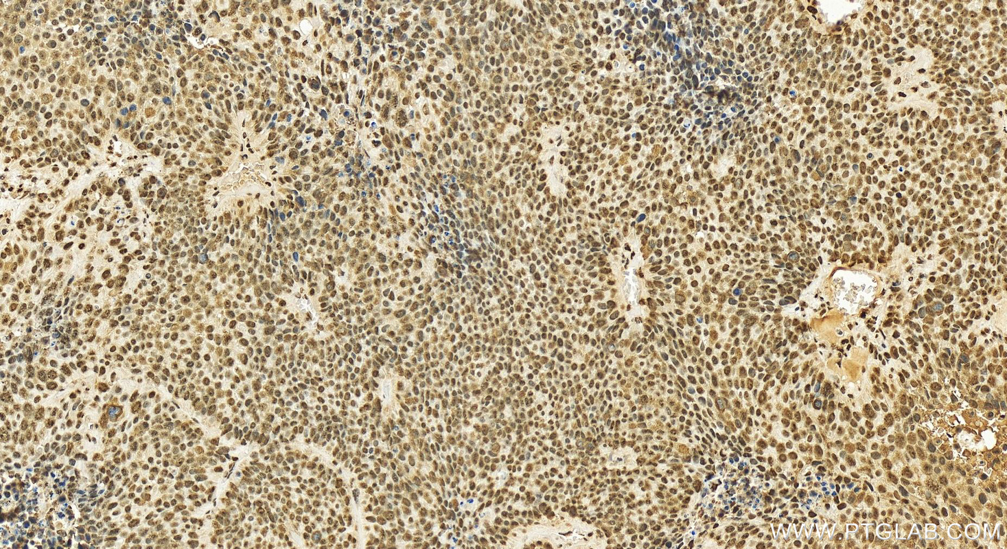 Immunohistochemistry (IHC) staining of human lung squamous cell carcinoma tissue using MCM6 Polyclonal antibody (13347-2-AP)