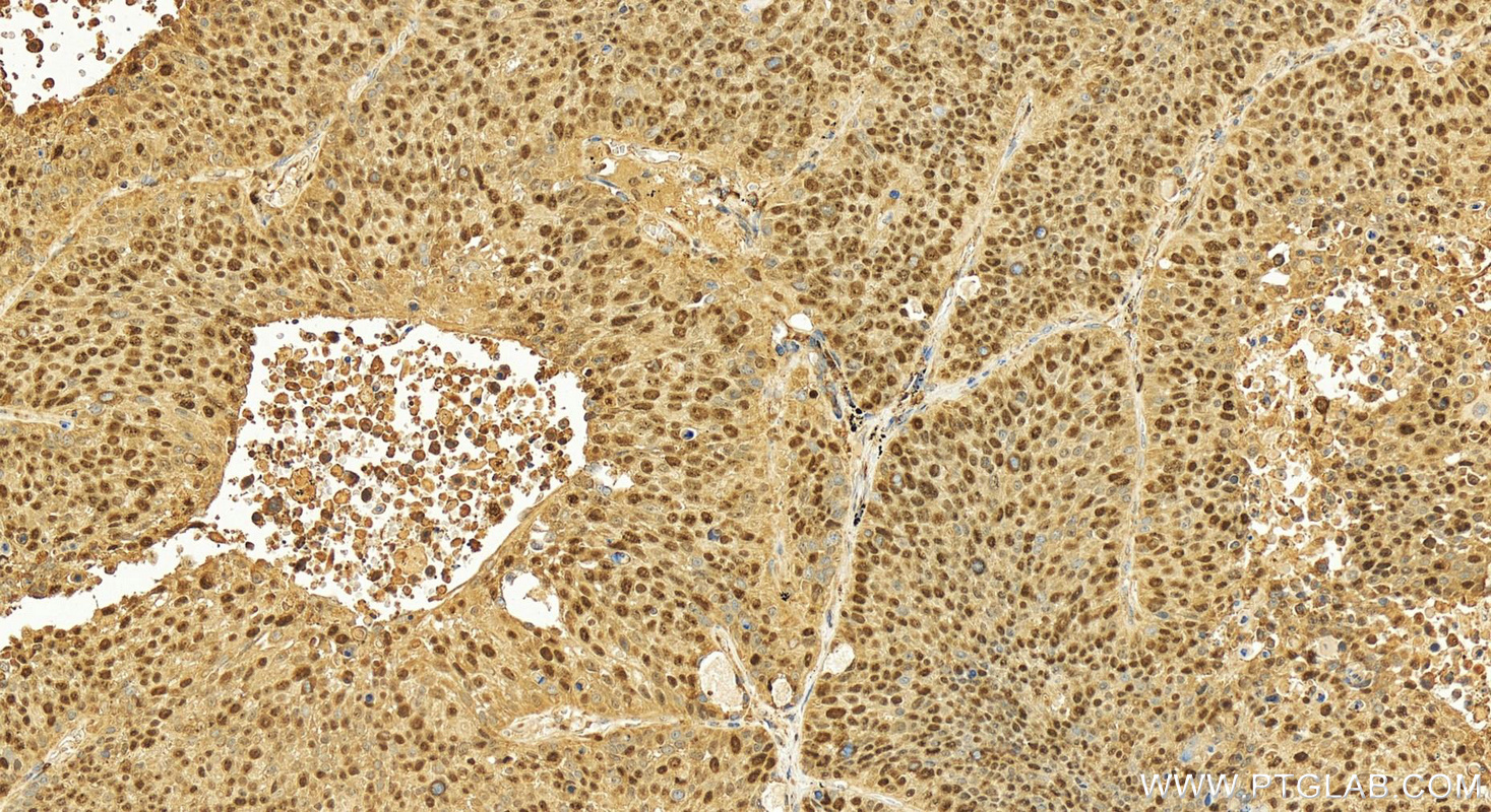 Immunohistochemistry (IHC) staining of human lung squamous cell carcinoma tissue using MCM7 Polyclonal antibody (11225-1-AP)