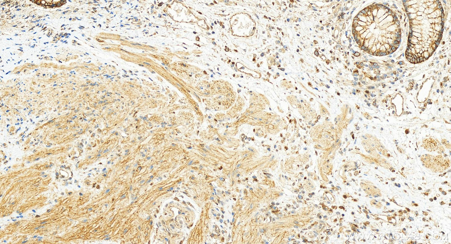 Immunohistochemistry (IHC) staining of human colon cancer tissue using MCT1 Polyclonal antibody (20139-1-AP)