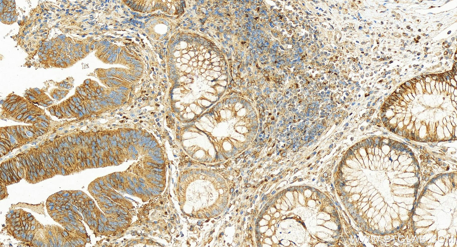 Immunohistochemistry (IHC) staining of human colon cancer tissue using MCT1 Polyclonal antibody (20139-1-AP)
