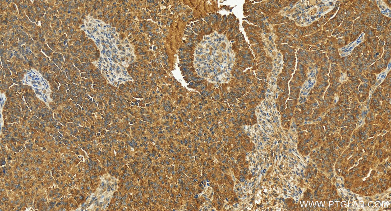 Immunohistochemistry (IHC) staining of human ovarian  cancer using MCTS1 Polyclonal antibody (14984-1-AP)