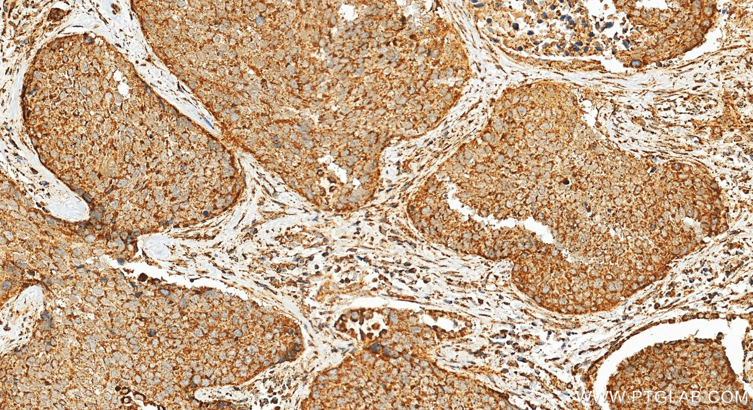 Immunohistochemistry (IHC) staining of human lung cancer tissue using MDH2 Polyclonal antibody (15462-1-AP)