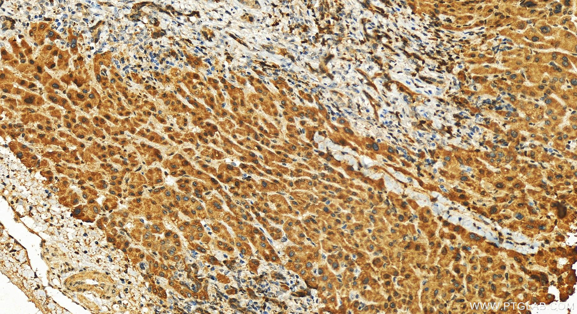 Immunohistochemistry (IHC) staining of human intrahepatic cholangiocarcinoma tissue using Midkine Polyclonal antibody (11009-1-AP)