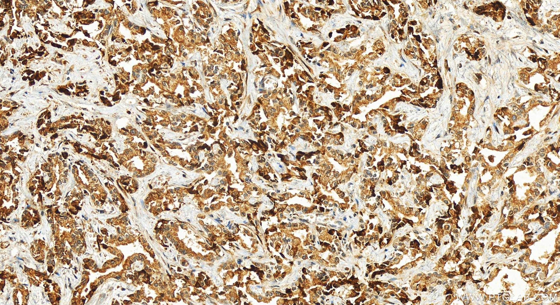 Immunohistochemistry (IHC) staining of human intrahepatic cholangiocarcinoma tissue using Midkine Polyclonal antibody (11009-1-AP)