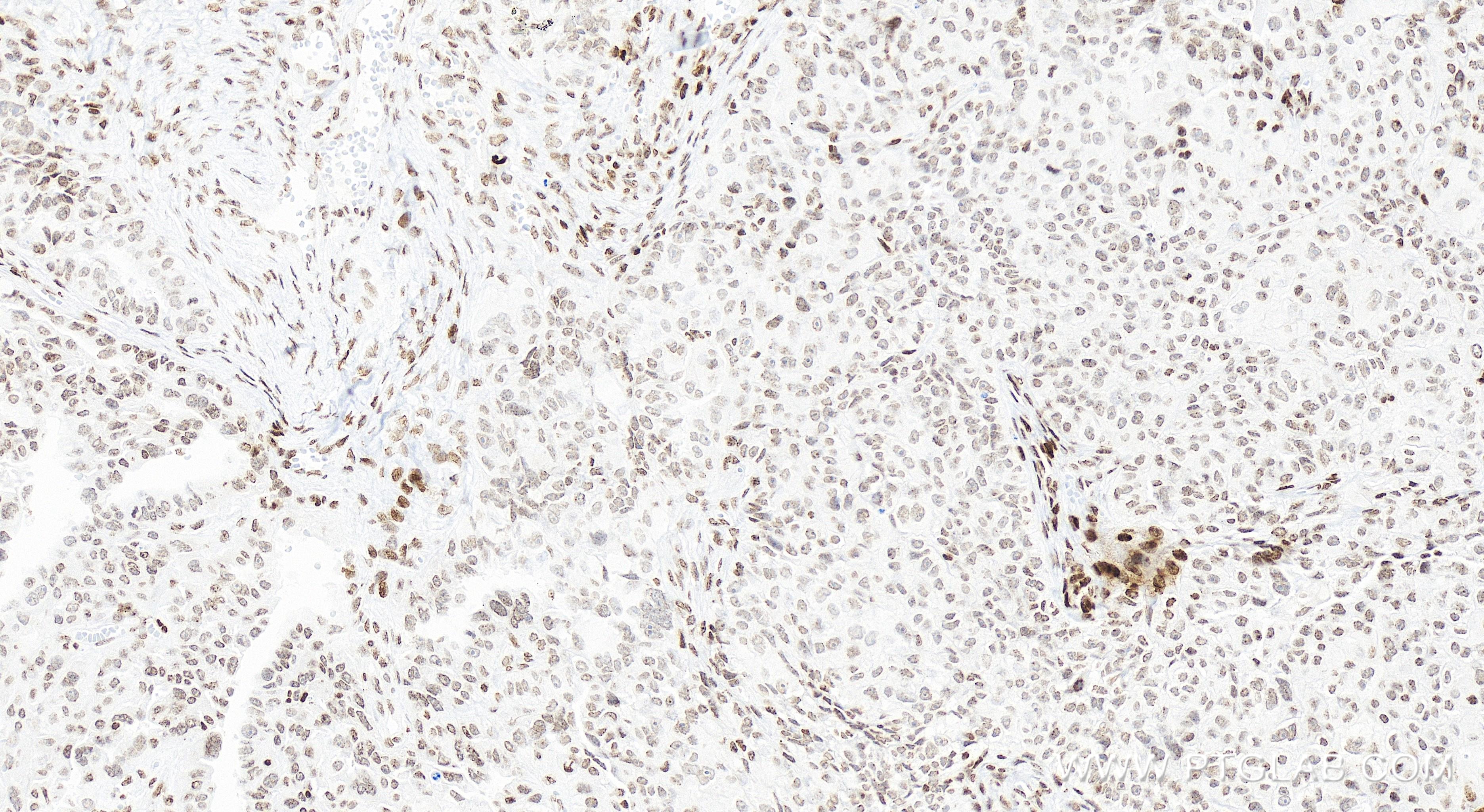 Immunohistochemistry (IHC) staining of human ovary cancer tissue using MDMX/MDM4 Recombinant antibody (84534-5-RR)