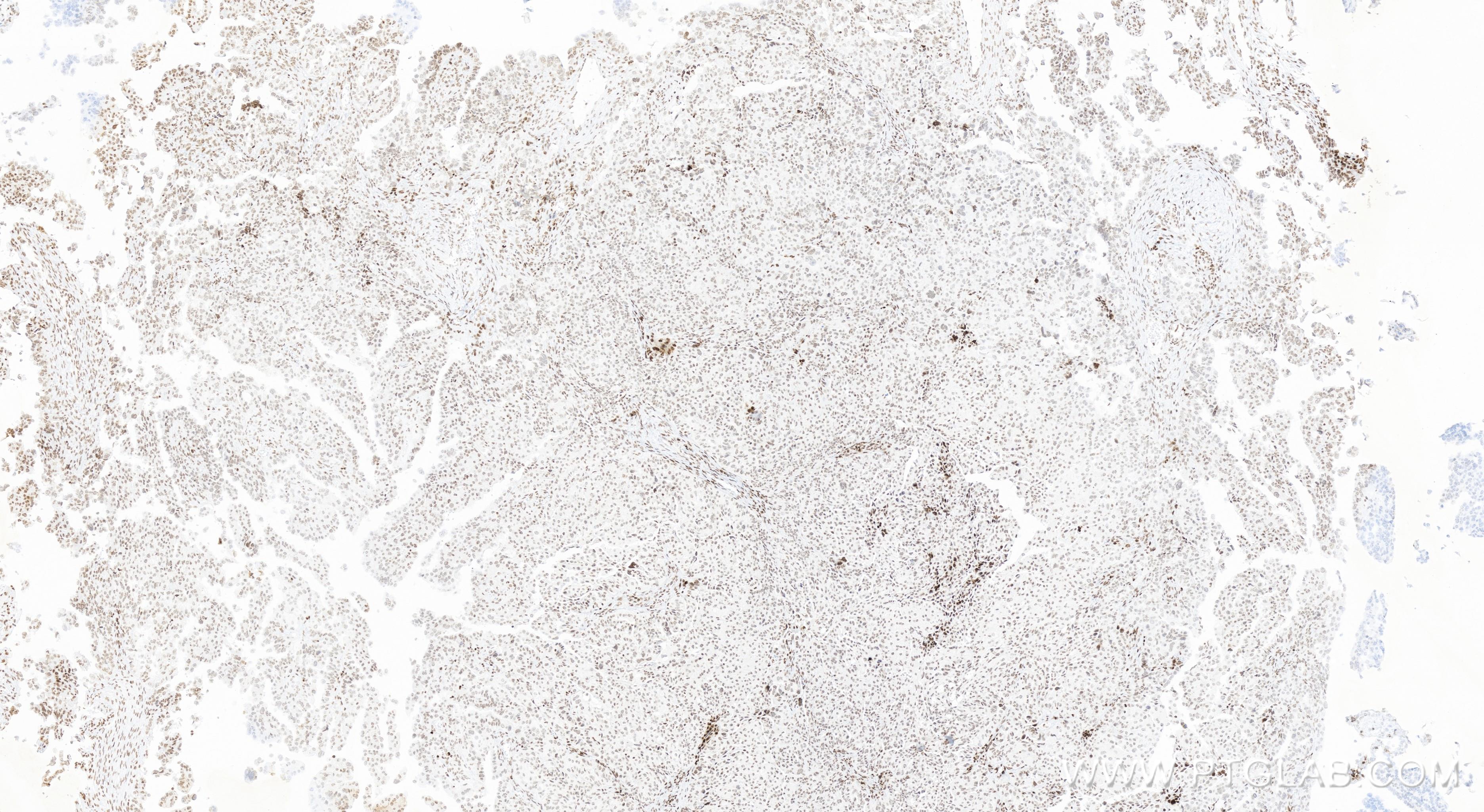 Immunohistochemistry (IHC) staining of human ovary cancer tissue using MDMX/MDM4 Recombinant antibody (84534-5-RR)