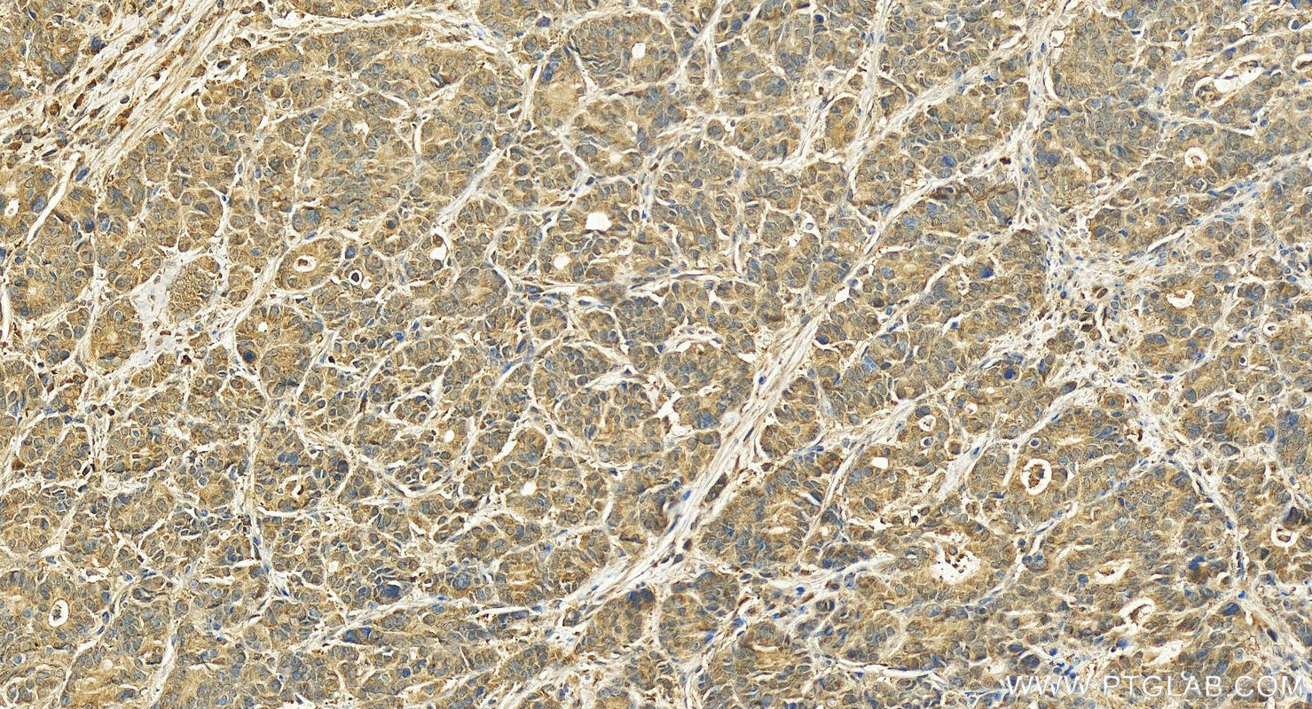 Immunohistochemistry (IHC) staining of human stomach cancer tissue using MED18 Polyclonal antibody (15352-1-AP)