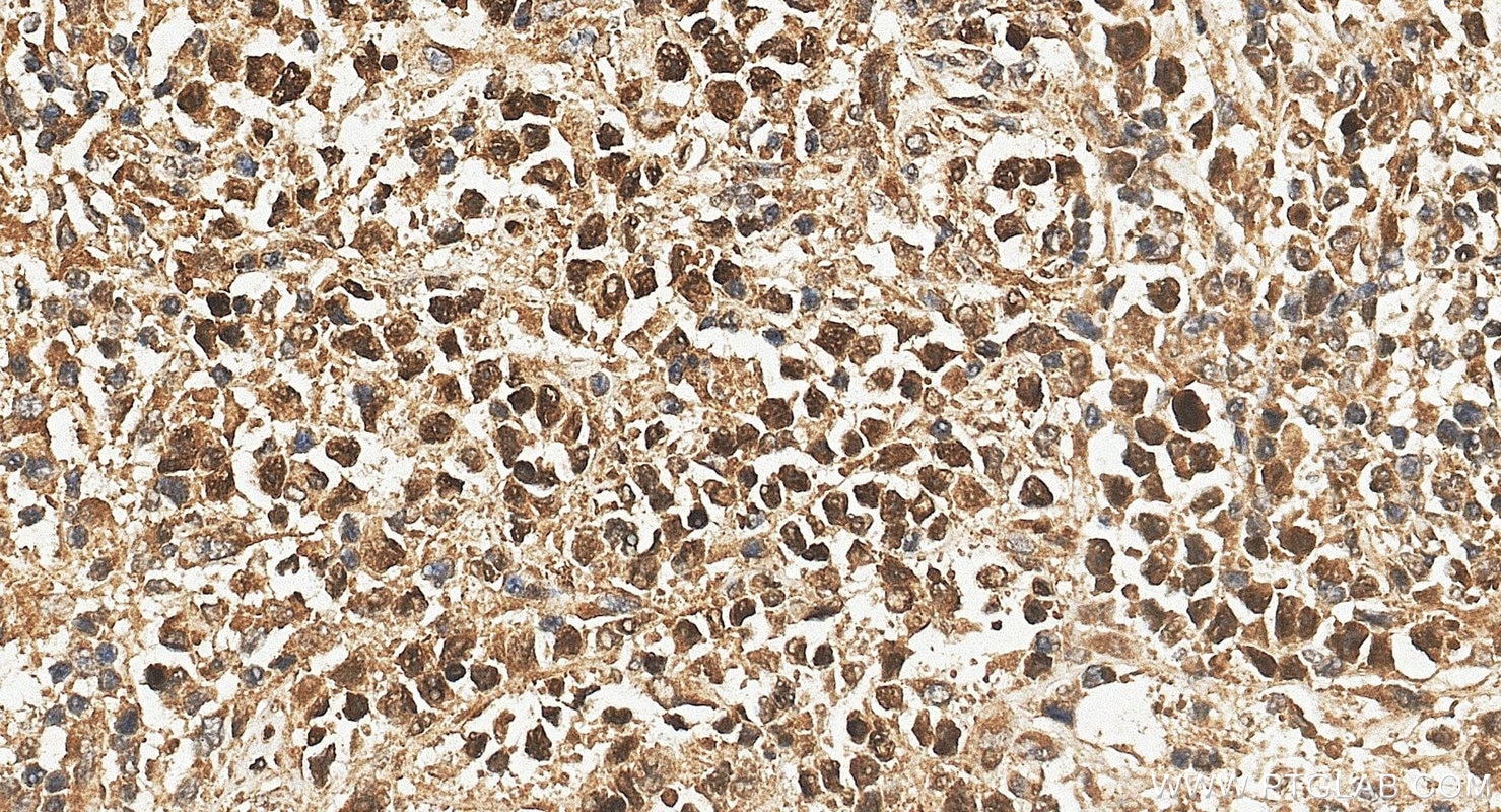 Immunohistochemistry (IHC) staining of human lymphoma tissue using MEF2C Polyclonal antibody (10056-1-AP)