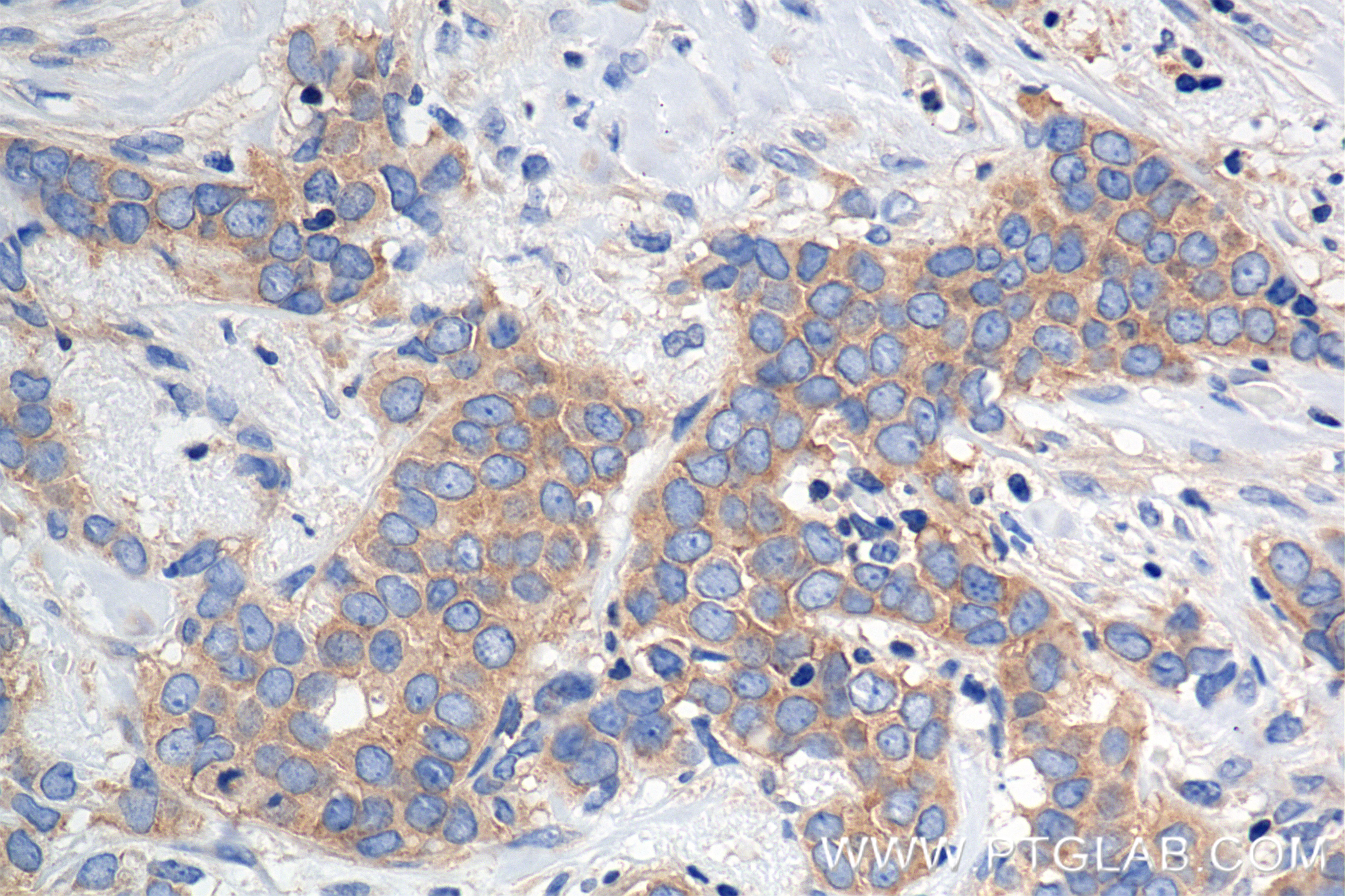 Immunohistochemistry (IHC) staining of human breast cancer tissue using MEK1/2 Recombinant antibody (84967-1-RR)