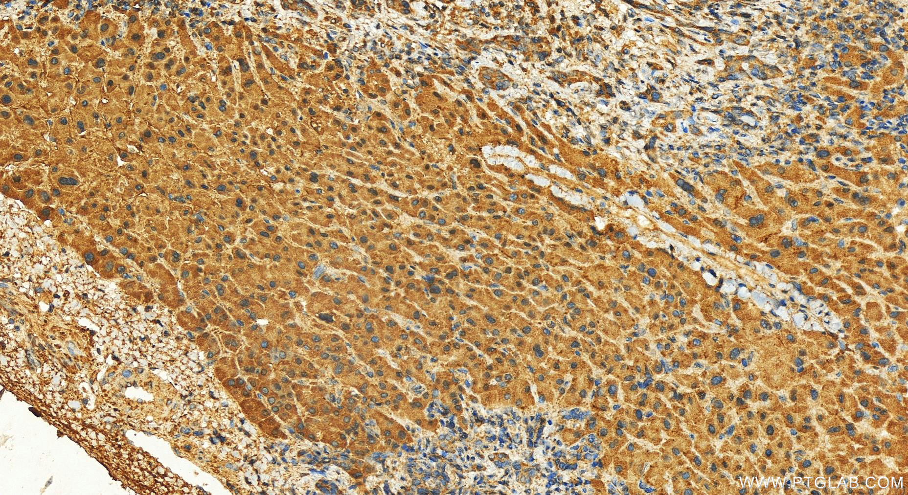 Immunohistochemistry (IHC) staining of human intrahepatic cholangiocarcinoma tissue using MEMO1 Polyclonal antibody (14604-1-AP)