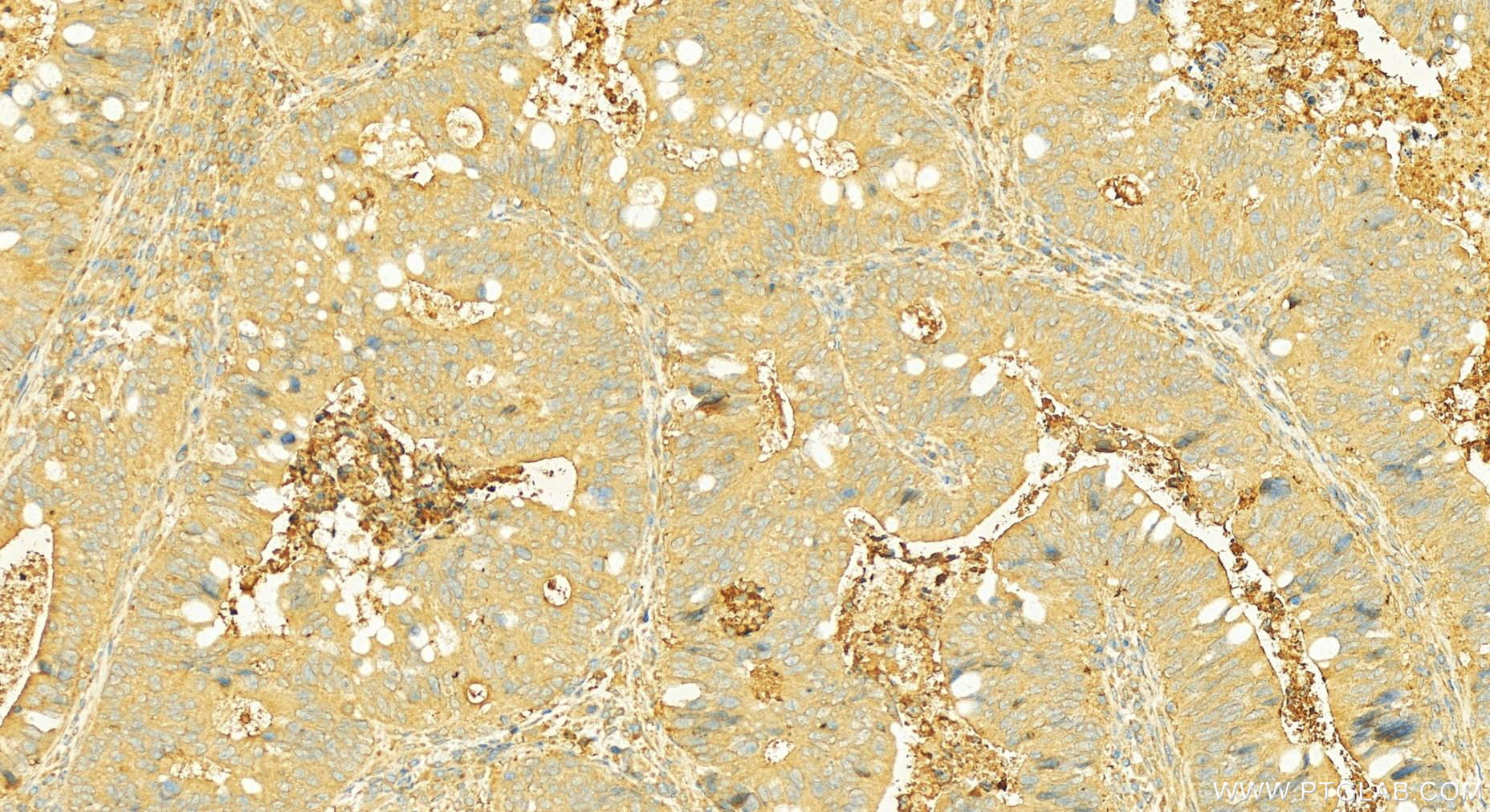 Immunohistochemistry (IHC) staining of human colon cancer tissue using MEP1A Polyclonal antibody (24640-1-AP)