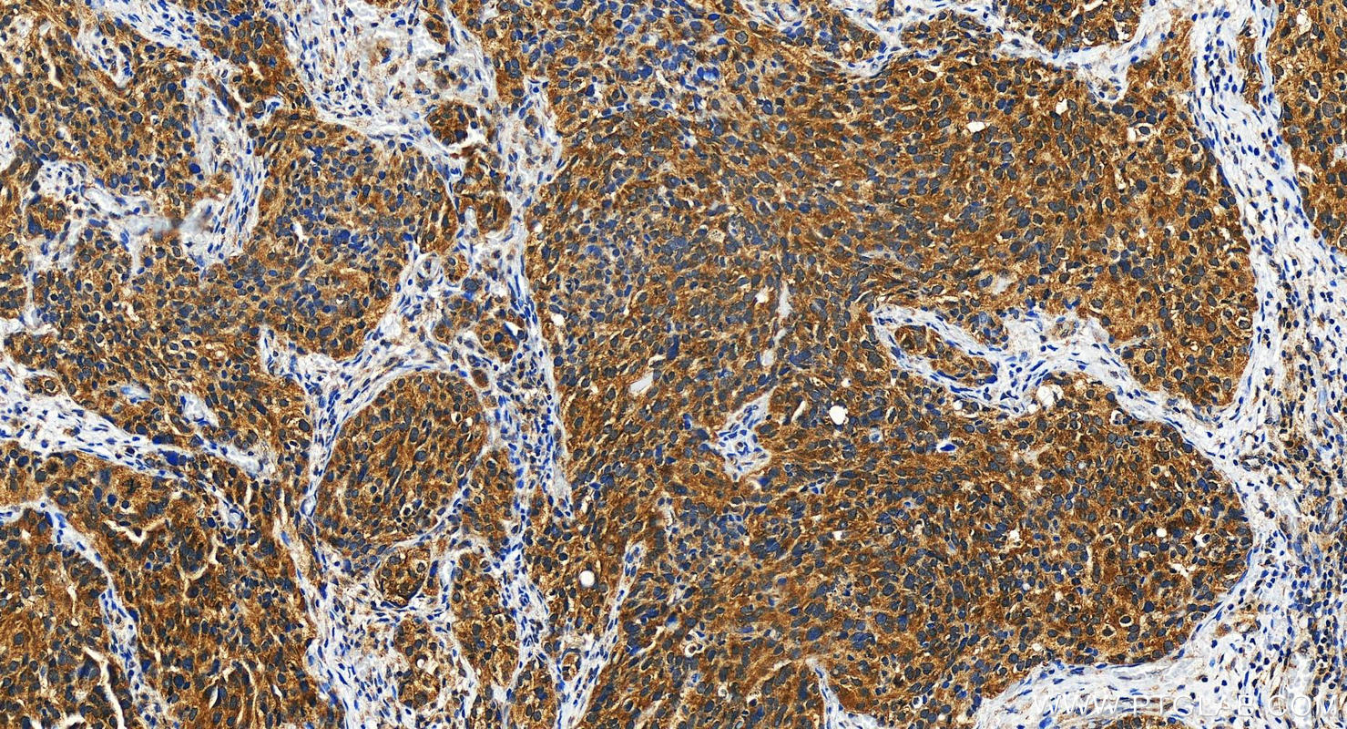 Immunohistochemistry (IHC) staining of human ovary cancer tissue using METAP1 Polyclonal antibody (28702-1-AP)