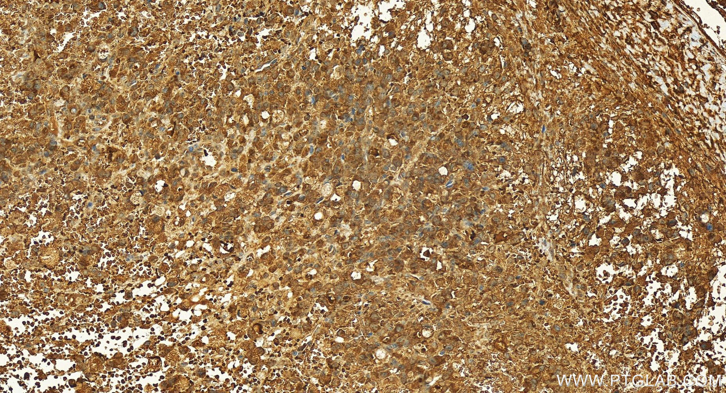 Immunohistochemistry (IHC) staining of human ovary cancer tissue using METTL11A Polyclonal antibody (17184-1-AP)