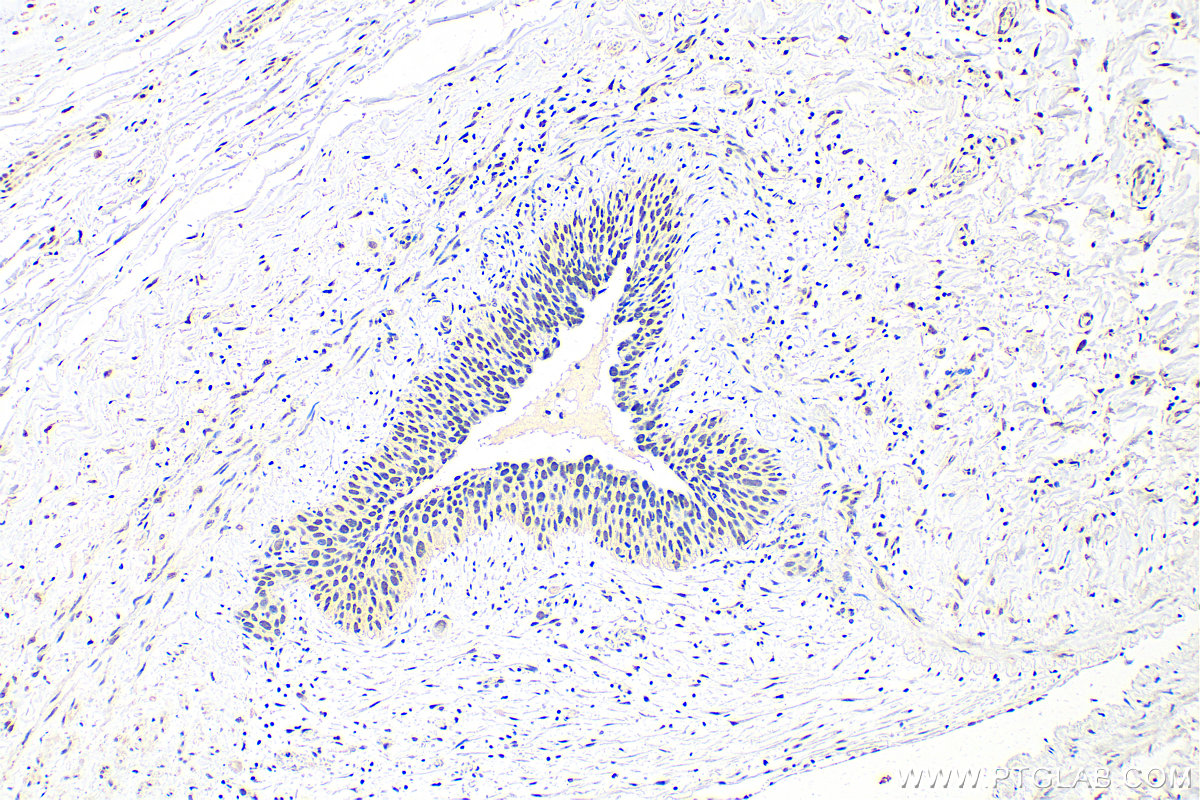 Immunohistochemistry (IHC) staining of human lung cancer tissue using METTL3 Polyclonal antibody (29314-1-AP)