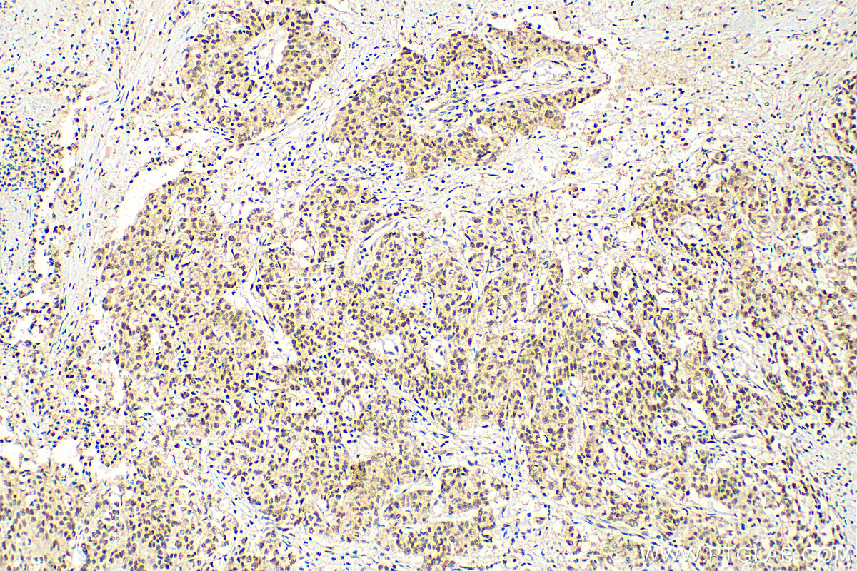 Immunohistochemistry (IHC) staining of human stomach cancer tissue using METTL3 Polyclonal antibody (29314-1-AP)